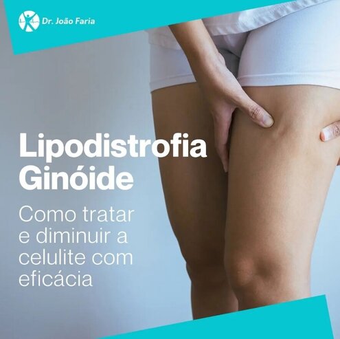 Lipodistrofia Ginóide - Como tratar e diminuir a celulite com eficácia