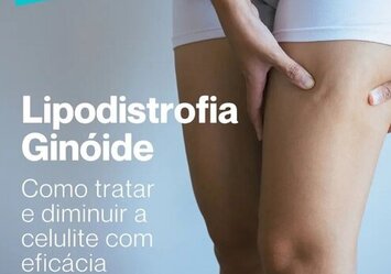 Lipodistrofia Ginóide - Como tratar e diminuir a celulite com eficácia