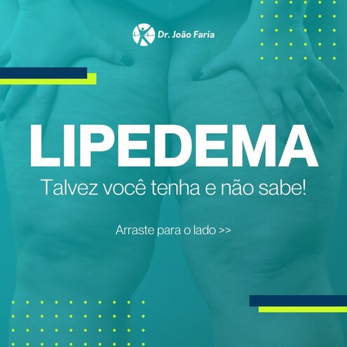 Lipedema - talvez você tenha e não sabe!