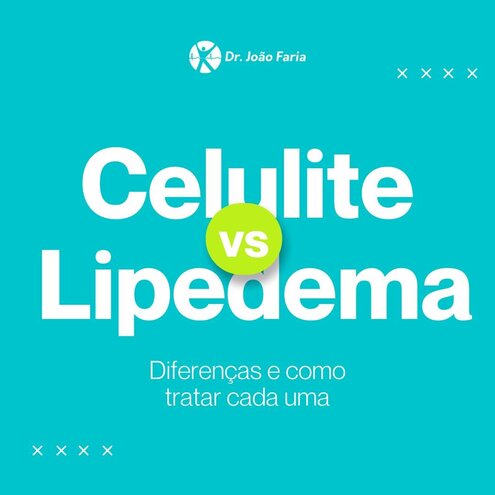 Celulite vs Lipedema - Diferenças e como tratar cada uma